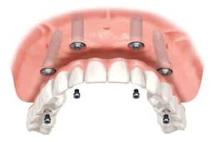 all-on-four-implants-1